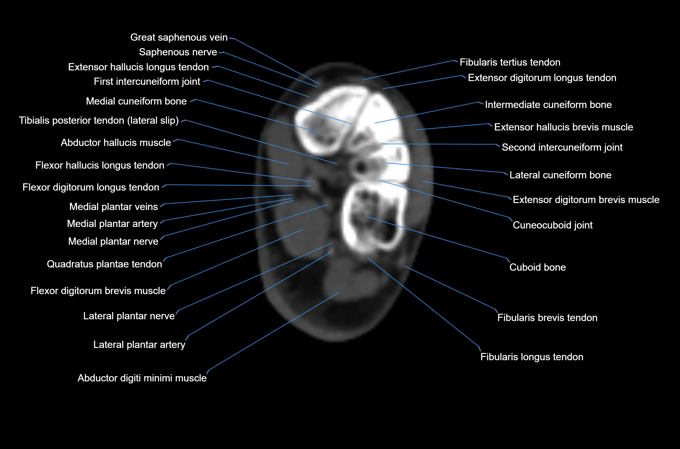 CT Ankle axial cross sectional anatomy labelled image -00051.webp
